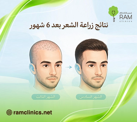 صورة-توضح-نتائج-زراعة-الشعر-بعد-6-شهور