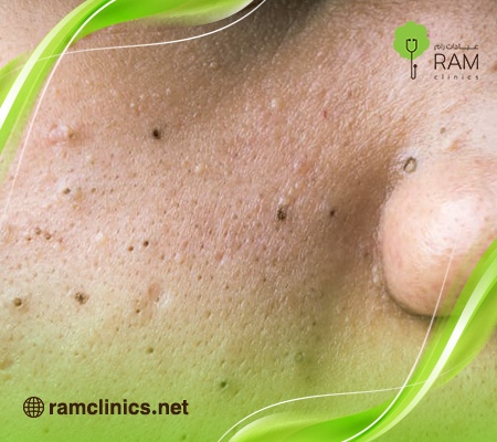 كيفية-التخلص-من-البثور-السوداء-في-الوجه