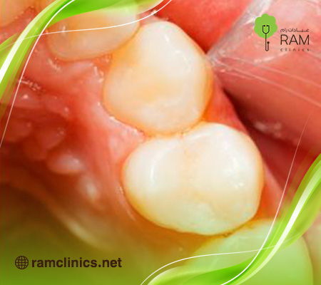 حشوة-الاسنان