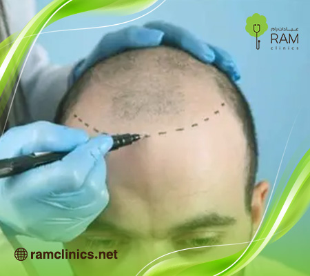 زراعة-الشعر-قبل-وبعد