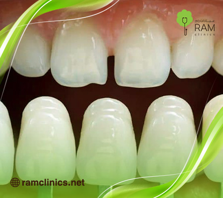 ما-هي-تركيبات-الزيركون