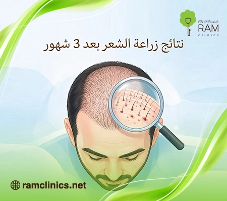 صورة-توضح-نتائج-زراعة-الشعر-بعد-3-شهور