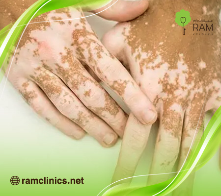 تكلفة-علاج-البهاق-بالليزر