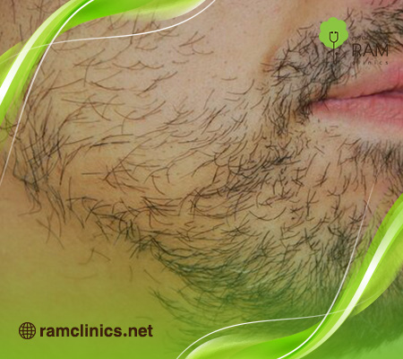 زراعة-الشنب-واللحية-في-السعودية