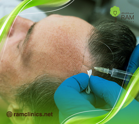 ابر-بلازما-للشعر