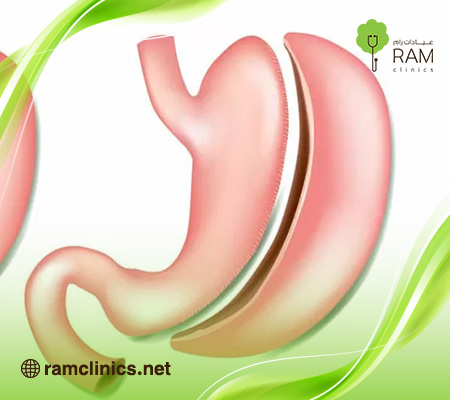 علامات-توسع-المعده-بعد-التكميم