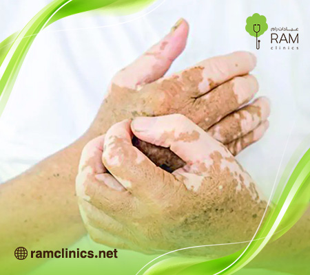 علاج-البهاق-بالليزر