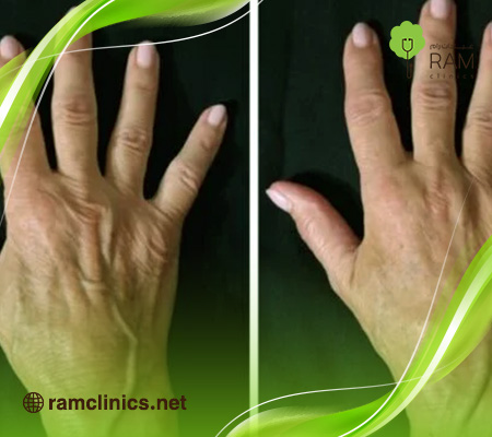 حقن-الدهون-الذاتية