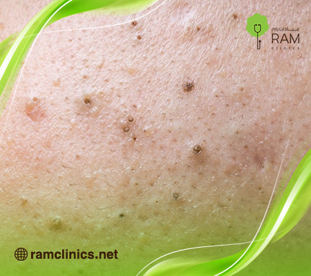 البثور-السوداء-في-الوجه