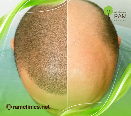 زراعة-الشعر-قبل-وبعد