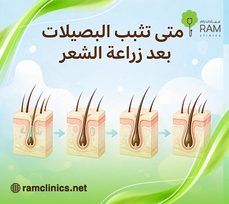 صورة-توضح-متى-تثبت-البصيلات-بعد-زراعة-الشعر 