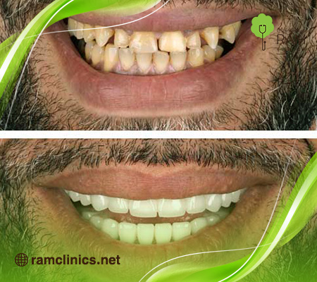 صورة-توضح-الفرق-بين-الأسنان-العادية-والأسنان-المثالية