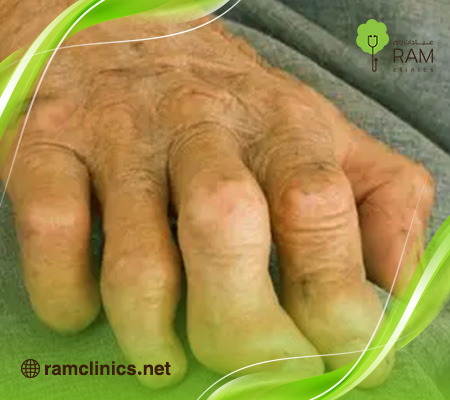 مضاعفات-مرض-الجذام