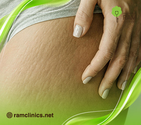 علاج-تشققات-الجسم-البيضاء