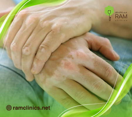 تجربتي-في-علاج-البهاق-بالليزر