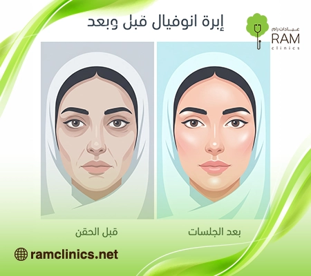 صورة-توضح-نتائج-ابرة-انوفيال-قبل-وبعد