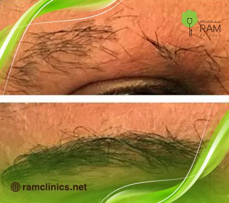 زراعة-الحواجب-للرجال-السعودية