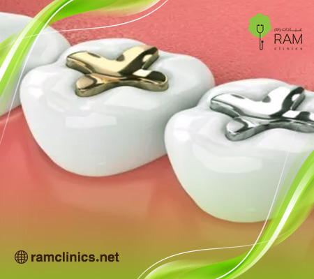 حشوة-الاسنان