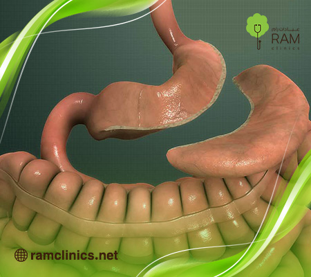 اسباب-توسع-المعده-بعد-التكميم