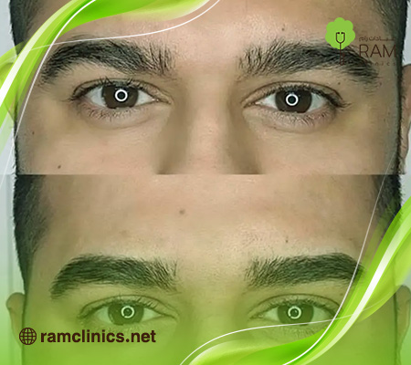 زراعة-الحواجب-للرجال-السعودية