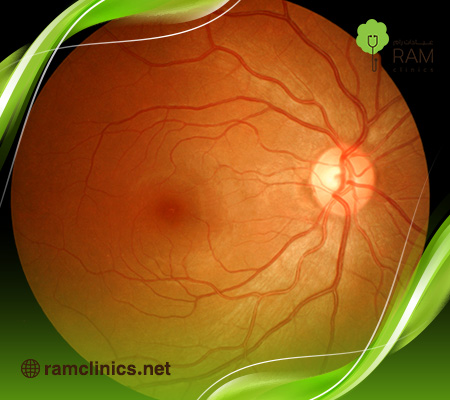 اعراض-ضمور-العصب-البصري