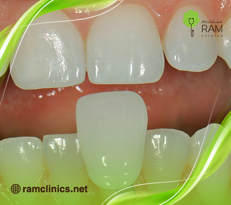 أنواع-تركيبات-الأسنان-الزيركون