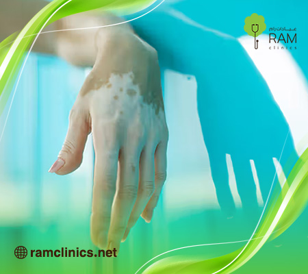 أفضل-دكتور-لعلاج-البهاق-في-جدة