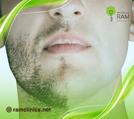 كل-ما-يخص-زراعة-اللحية