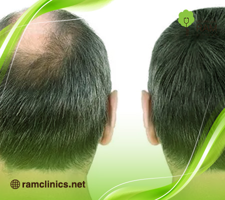 رسم-خط-الجبهة-في- زراعة-الشعر