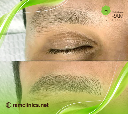 زراعة-الحواجب-للرجال-السعودية