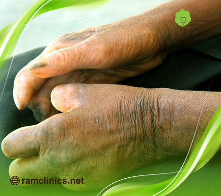 ما-هو-الجذام