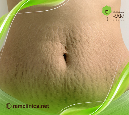 تشققات-الجسم