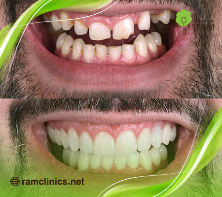 صورة-توضح-الفرق-بين-الابتسامة-العادية-والابتسامة-المثالية
