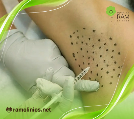 بوتكس-تعرق بوتكس-تعرق